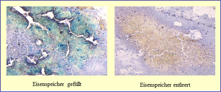 Entstehung von ZPP bei eisendefizitärer Erythropoese