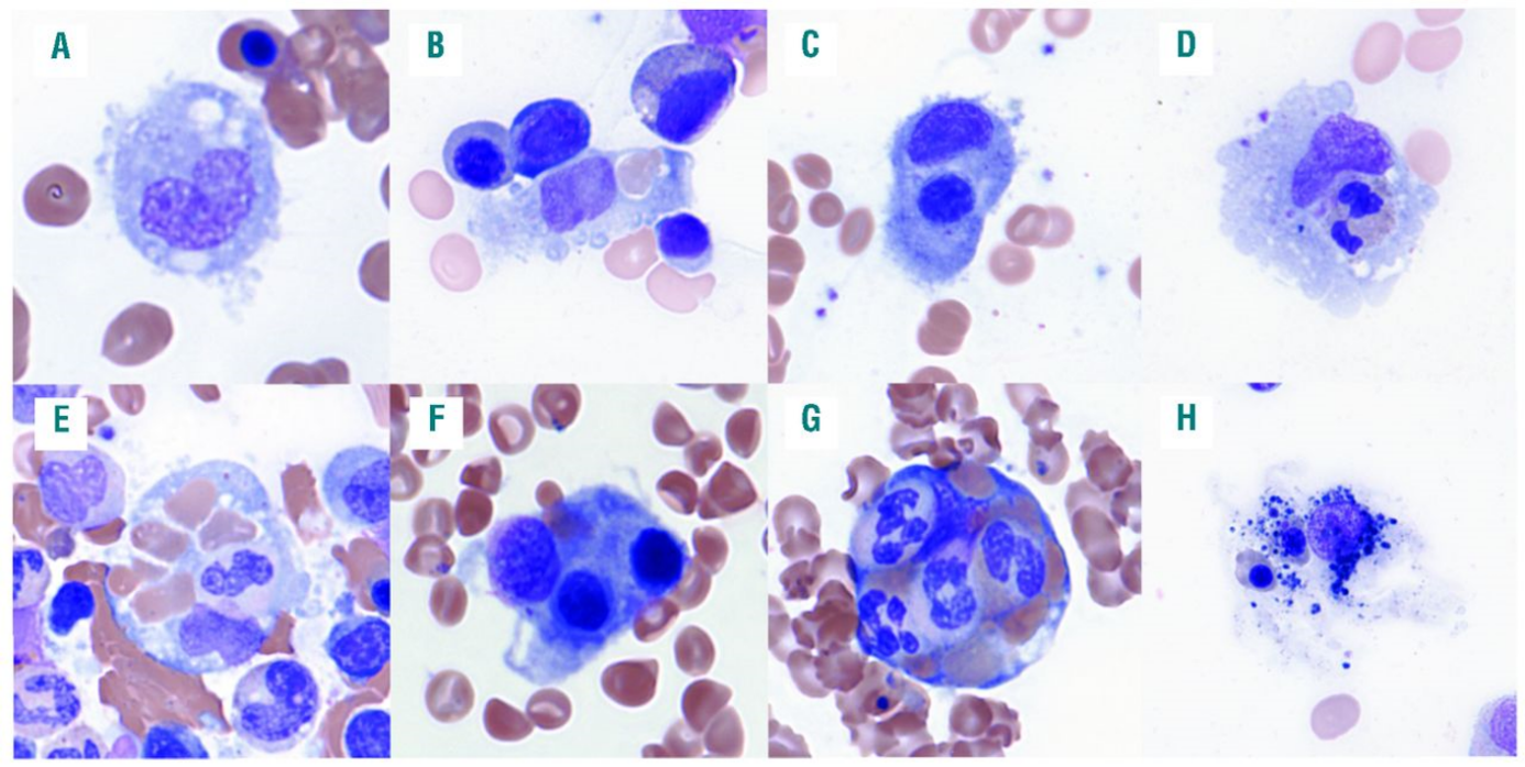 Hämophagozytose im Knochenmark (mit Genehmigung Abbildung aus Gars et al., 2018) 2
